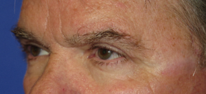 Eyelid Lift Case 5498 After Photo Eyelid Lift