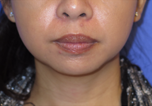 Chin Liposuction Case 5456 Before Photo Chin Liposuction