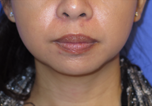 Chin Liposuction