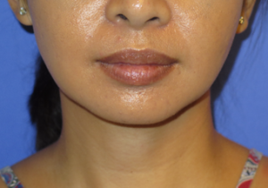 Chin Liposuction Case 5456 After Photo Chin Liposuction
