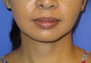 Chin Liposuction