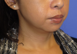 Chin Liposuction Case 5456 Before Photo Chin Liposuction