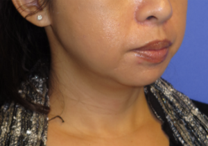 Chin Liposuction