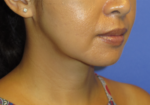 Chin Liposuction