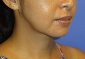 Chin Liposuction Case 5456 After Photo Chin Liposuction