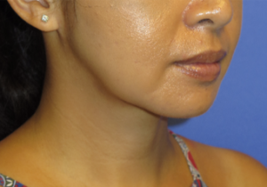 Chin Liposuction