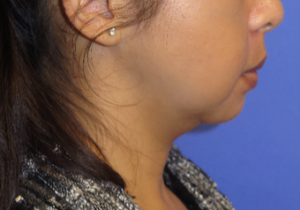 Chin Liposuction Case 5456 Before Photo Chin Liposuction
