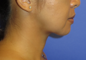 Chin Liposuction Case 5456 After Photo Chin Liposuction
