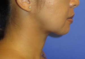 Chin Liposuction