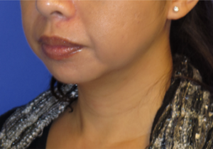 Chin Liposuction Case 5456 Before Photo Chin Liposuction