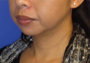 Chin Liposuction