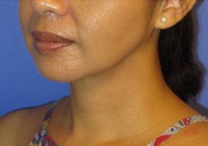 Chin Liposuction Case 5456 After Photo Chin Liposuction