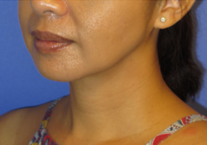 Chin Liposuction