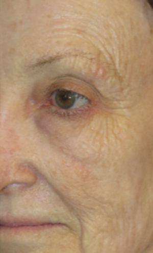 Laser Resurfacing