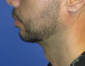 Chin Implant Case 5412 After Photo Chin Implant