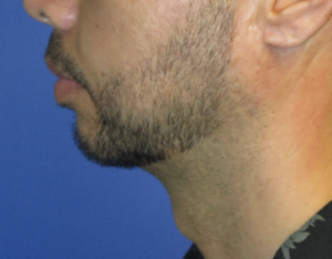 Chin Implant