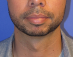 Chin Implant