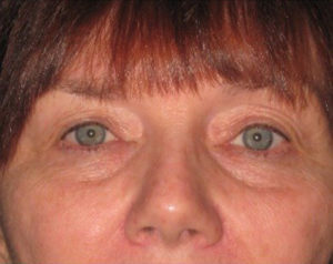 Eyelid Lift