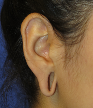 Ear Surgery Case 5385 Before Photo Ear Surgery