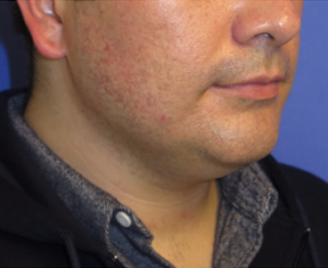 Chin Liposuction Case 5449 Before Photo Chin Liposuction