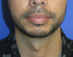 Chin Implant