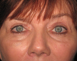 Eyelid Lift