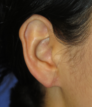 Ear Surgery Case 5385 After Photo Ear Surgery