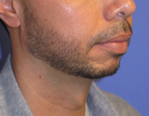 Chin Implant Case 5412 Before Photo Chin Implant
