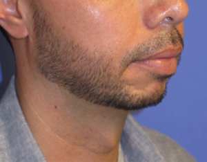 Chin Implant