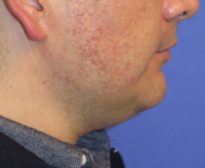 Chin Liposuction Case 5449 Before Photo Chin Liposuction