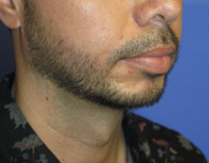 Chin Implant Case 5412 After Photo Chin Implant