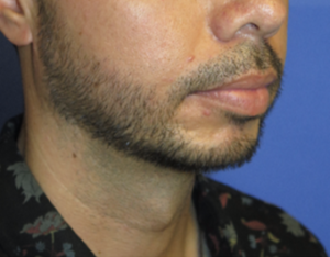 Chin Implant