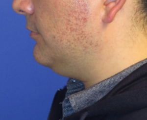 Chin Liposuction Case 5449 Before Photo Chin Liposuction