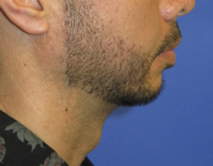 Chin Implant Case 5412 After Photo Chin Implant