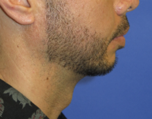 Chin Implant