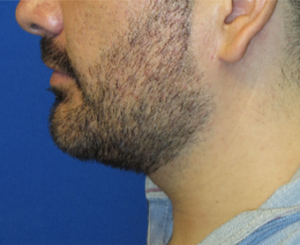 Chin Liposuction Case 5449 After Photo Chin Liposuction