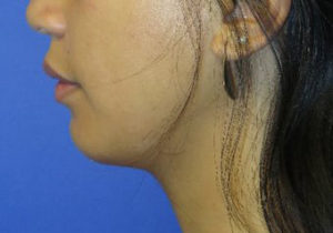 Chin Implant