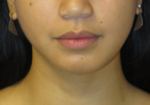 Chin Implant