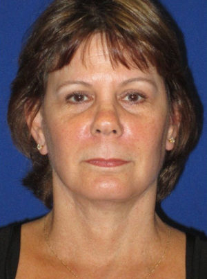 FACEology Lift / Neck Lift Case 5665 After Photo FACEology Lift / Neck Lift