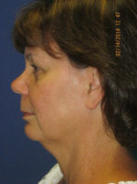 FACEology Lift / Neck Lift