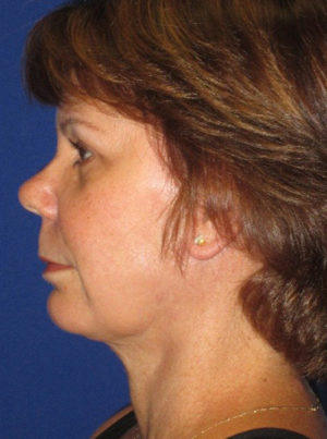 FACEology Lift / Neck Lift Case 5665 After Photo FACEology Lift / Neck Lift