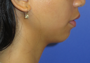 Chin Implant