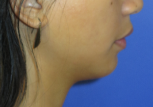 Chin Implant