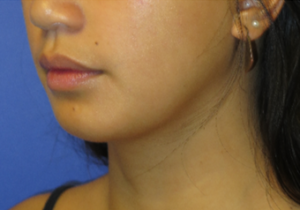 Chin Implant