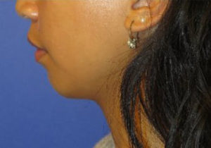 Chin Implant