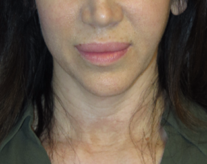 FACEology Lift / Neck Lift Case 5745 Before Photo FACEology Lift / Neck Lift