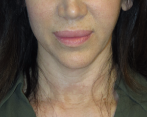 FACEology Lift / Neck Lift