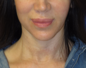 FACEology Lift / Neck Lift Case 5745 After Photo FACEology Lift / Neck Lift