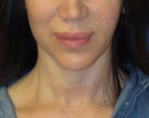 FACEology Lift / Neck Lift