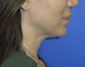 FACEology Lift / Neck Lift Case 5745 Before Photo FACEology Lift / Neck Lift